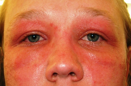 Swollen Eyelids: Causes And Treatment - All About Vision