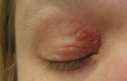 How to deal with eczema around the eyes? | Mumsnet Discussion