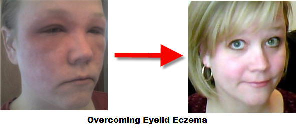 overcoming eyelid eczema - January 2009 vs. January 2010